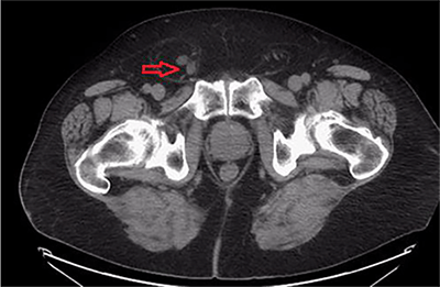 Figure 1. Axial view of CT showing bilateral fat-containing inguinal hernias with the right side containing the ureter.