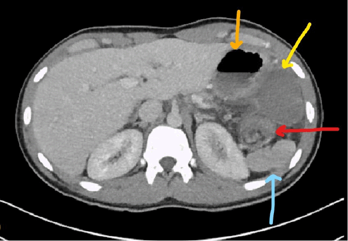Stomach (orange arrow), accessory spleen (yellow arrow), "swirl sign" (red arrow), and native spleen (blue arrow)