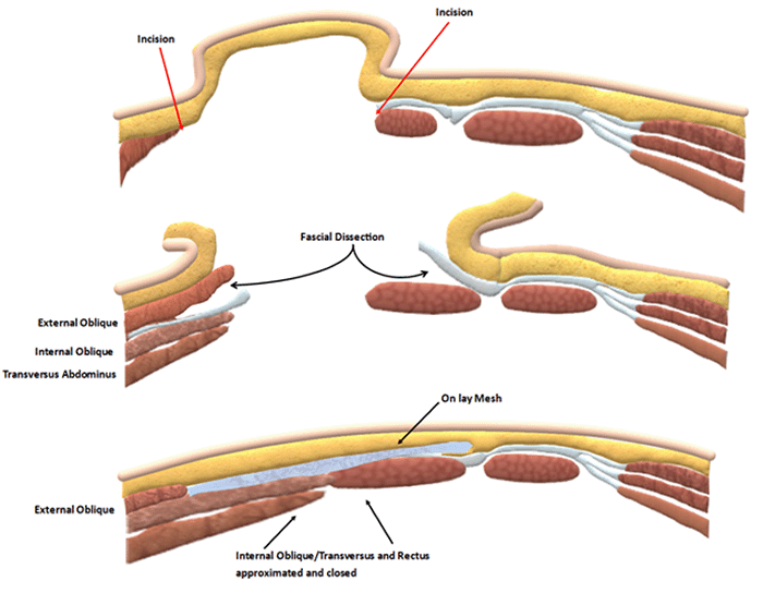 Lateral and Anterior Fascial Release with Onlay Mesh An Elegant