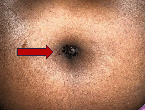 Clinical photograph of the patient’s umbilicus prior to surgical intervention. Note visible nodularity and superficial discoloration of the umbilical skin, with evidence of dried blood consistent with the patient's history of cyclical umbilical bleeding