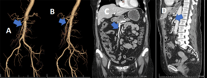 Figure 2. Preoperative CTA of Abdomen and Pelvis (C, D) with 3D Reconstruction (A, B) Revealing Patent Superior Mesenteric Artery (arrow). Published with Permission