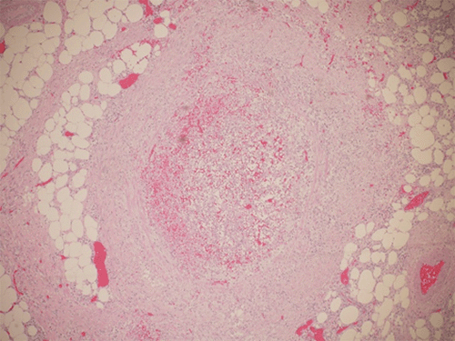 A) Inferior Mesenteric Vein Thrombus 