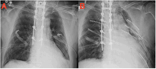 Surgical Stabilization of Rib Fractures Alleviates Debilitating Axial ...