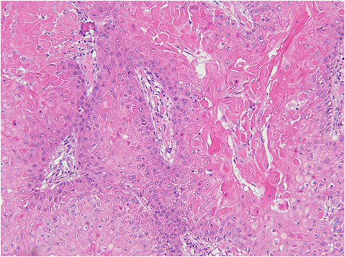 C, 200x) Squamous cells with minimal cytologic atypia and abundant keratin are observed