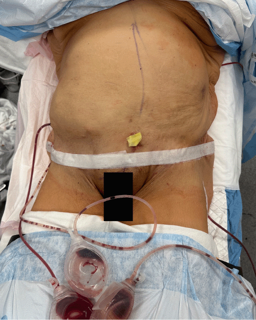 Clinical photograph at the conclusion of the procedure, showing the closed abdominal incision and the placement of three JP drains