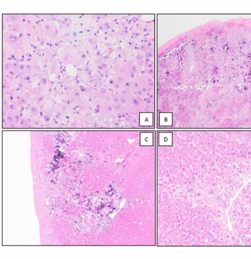 A) High-power magnification demonstrates marked cholestasis and cholate stasis; B, low-power magnification of the liver wedge biopsy reveals marked subcapsular calcifications, hemorrhage, and inflammation; C, High-power magnification of the liver wedge biopsy shows an additional subcapsular area with dense calcifications; D, High-power magnification of the liver wedge biopsy demonstrates cholestatic changes around a central vein without involvement by calcifications