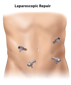 Colectomy | ACS