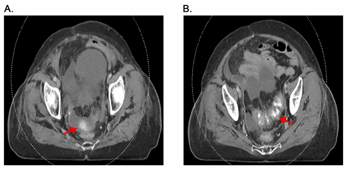 Figure 1. Pre-operative CT imaging. A. Complex free fluid with evidence of extraluminal contrast (red arrow), consistent with bowel perforation.B. Sigmoid colonic thickening (red arrow) with pericolonic fat stranding and complex pelvic ascites.