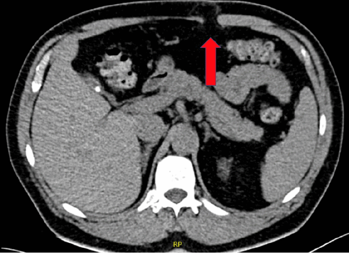 CT scan of the abdomen demonstrating a ventral hernia through a defect in the right upper quadrant