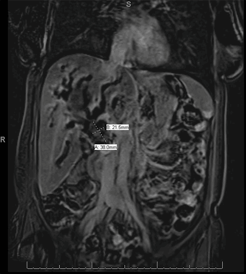Figure 1. MRI of abdomen and pelvis showing a 2 x 3 cm mass at the hepatic hilum and surrounded by an 8 x 12 cm hematoma. Coronal (SUB_COR Post) view.