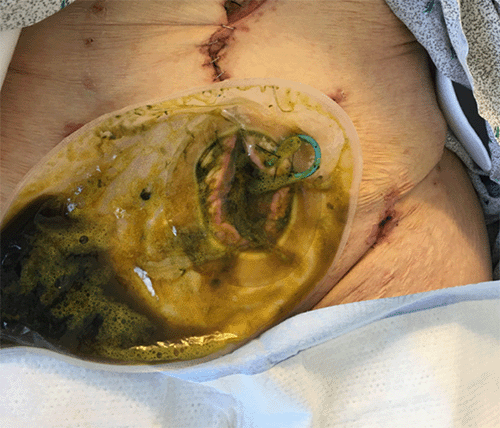 Stent traverses the colocutaneous fistula and internal end interfaces with the lumen of the sigmoid colon, draining into ostomy appliance.