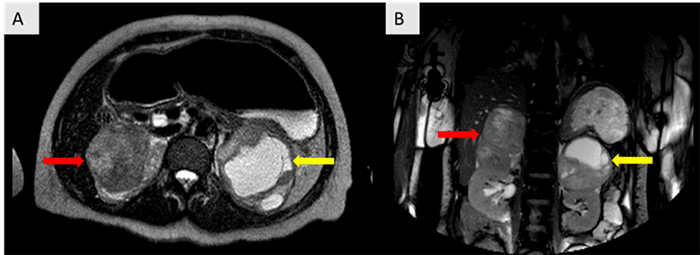 A) Axial and B) coronal MRI showing a 7.4 × 7.2 × 11.6 cm heterogeneous mildly T2 hyperintense lobulated lesion arising from the right adrenal gland (red arrows). A 9.9 × 9.1 × 8.3 cm heterogeneous lobulated exophytic lesion with an area of cystic/necrotic changes arising from the left adrenal gland (yellow arrows). These lesions likely contain hemorrhagic complement