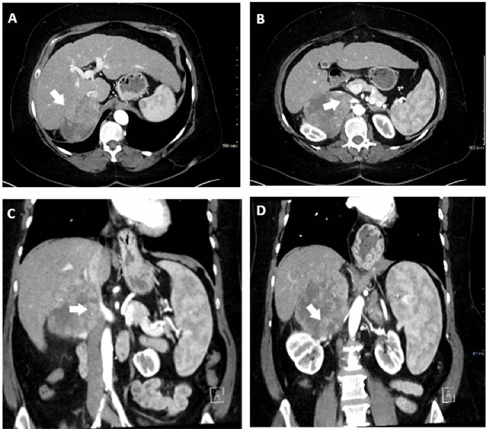 (A) An 11.0 × 9.7 × 7.1 cm tumor located in the hepatorenal recess of a cirrhotic liver. (B) The tumor, arising from liver segment VII, exhibiting direct contact with the inferior vena cava (arrow); (C) an extensive tumor-vena cava interface, extending superiorly from the hepatic confluence to the renocaval junction and inferiorly to the renal pelvis (D).