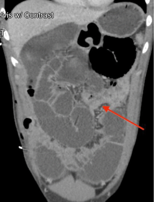 (F) Axial view showing collapsed bowel located proximal to the anastomosis