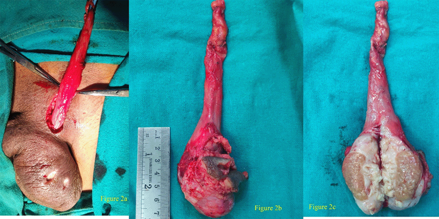 Intraoperative Photo of Scrotum