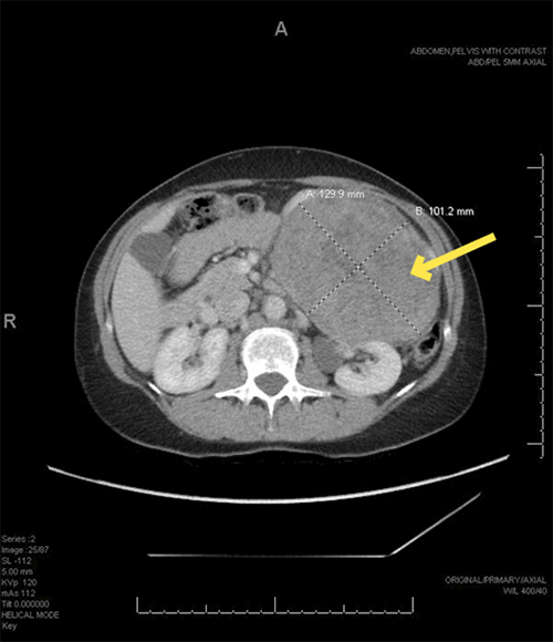 A) Axial at its largest dimensions; images were used for preoperative planning and visualization of planes of dissection