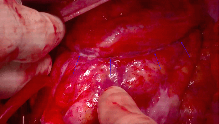 Note clear demarcation indicating the area of strangulation within the pericardial defect (arrows)