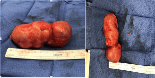 Figure 2. Retroperitoneal mass gross specimen