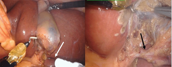 Sulcus of Rouvière (white arrow); cystic duct (black arrow)