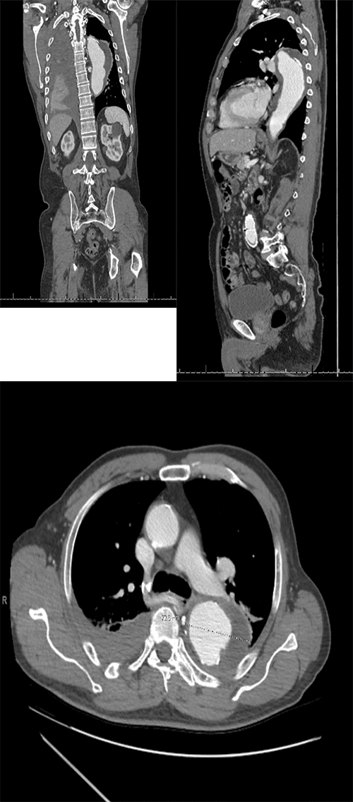 (Left to right) A large descending thoracic aortic aneurysm measuring up to 7.5 cm in diameter with a 2.5 cm thrombus on the left lateral aspect. Additionally, there are non-displaced fractures of the right clavicle and ribs 2-6 with associated hemothorax on the right side