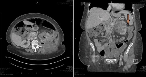 C) Coronal view on the left showing the connection between the descending colon and left kidney (arrow) and the same pathology shown on the axial view on the left indicated by crossmarker. 
