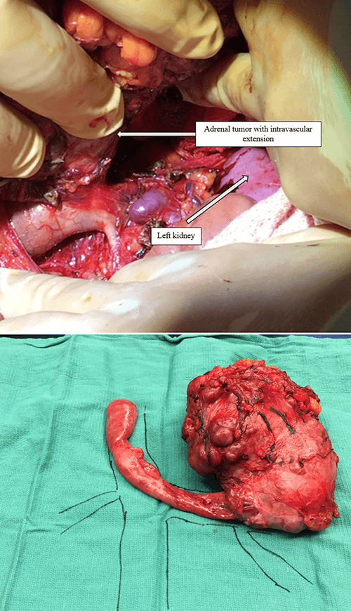 Figure 4. The surgical specimen in situ (A) and resected (B)