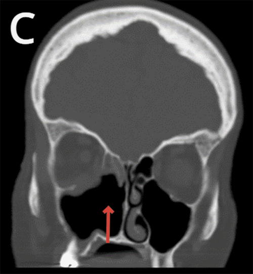 C) Arrow pointing at ill-defined inferior rectus muscle