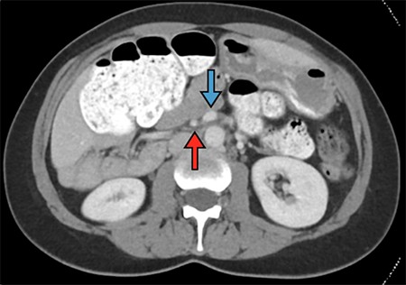 Figure 2. Note the SMV (blue arrow) abnormally positioned to the left of the SMA (red arrow).