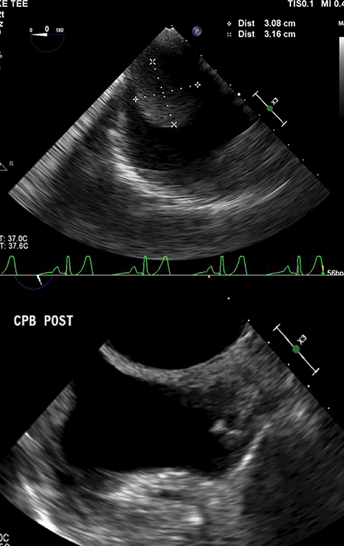Figure 3: Intraoperative transesophageal echocardiogram before (A) and after (B) tumor resection