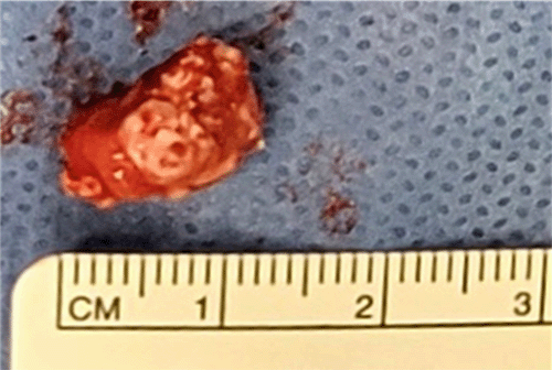 Gross specimen following excision, measuring 1.4 × 0.7 × 0.7 cm