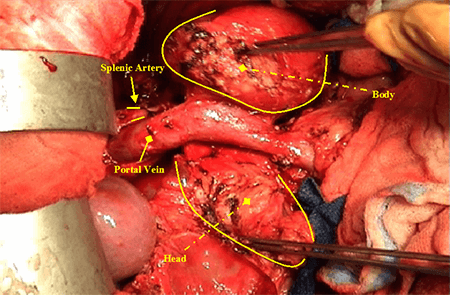Figure 1. “Open book maneuver”. Yellow arrows from top to bottom of the figure are pointing to head of the pancreas, portal vein, splenic artery, body of the pancreas.