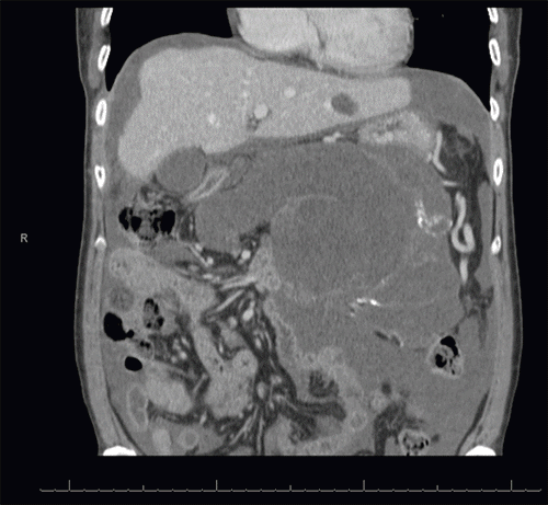 This image reveals the extensive 19.6 cm × 12.3 cm × 13.9 cm multiseptated cystic mass occupying a significant portion of the abdominal cavity. Note the associated mass effect on adjacent organs and the presence of moderate intra-abdominal ascites