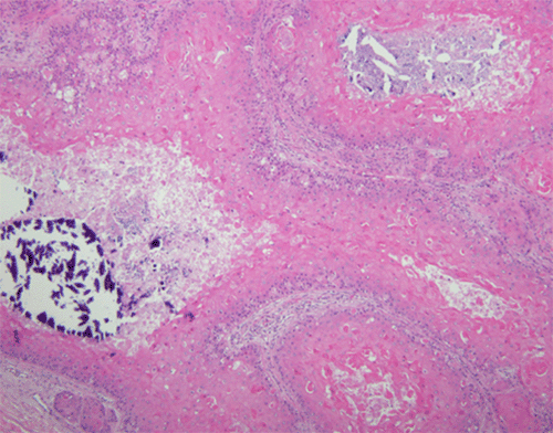 B, 100x) Cystic regions with keratinization lacking a granular layer (arrow) and peripheral palisading of the basal layer are evident