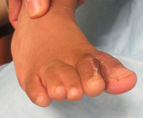 Figure 11. Six months postoperative pictures of syndactyly repair of 1st web space.