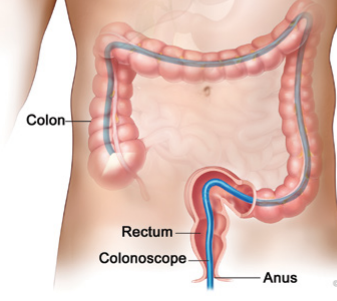 Colonoscopy