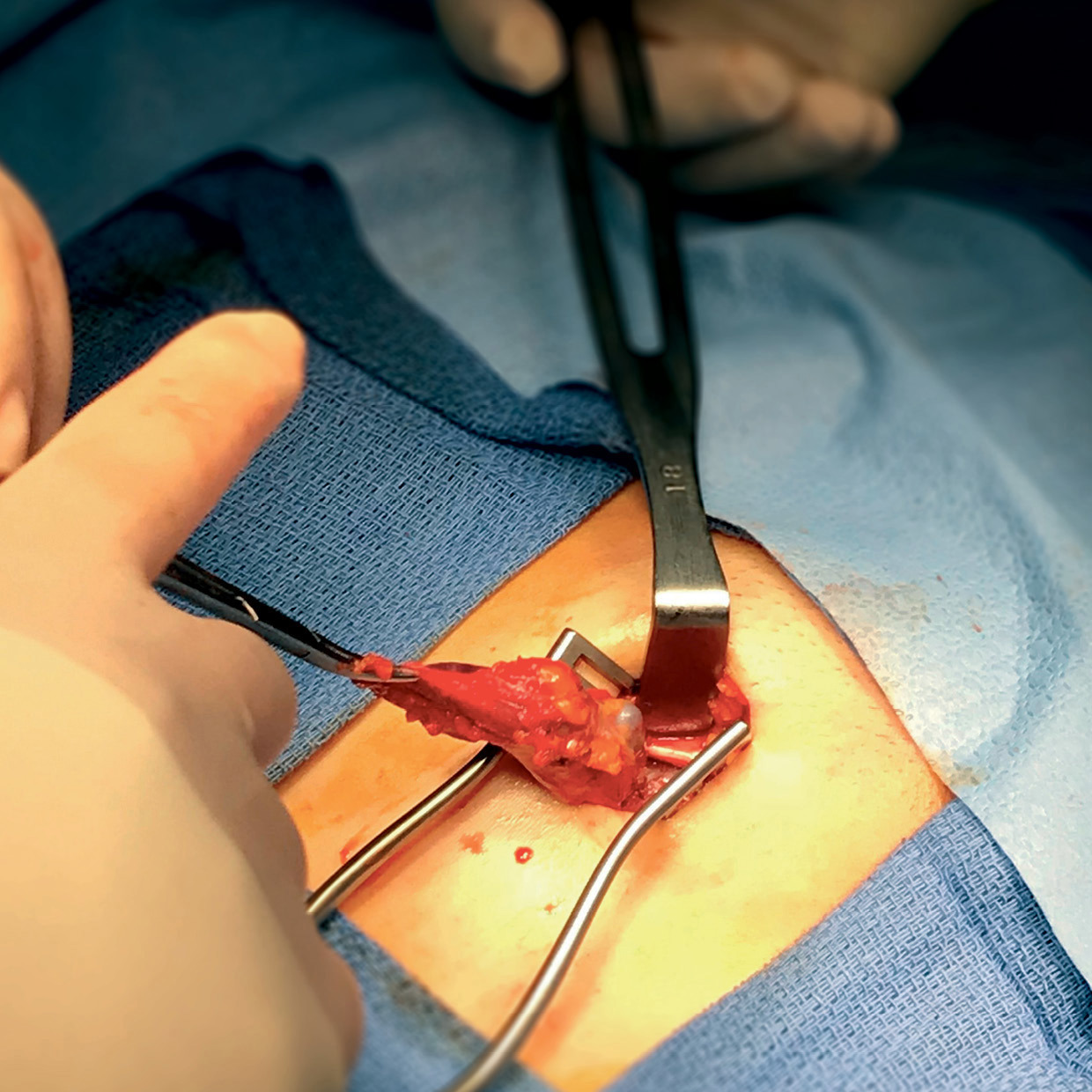 Hernia Repair Isn’t a One-Size-Fits-All Procedure