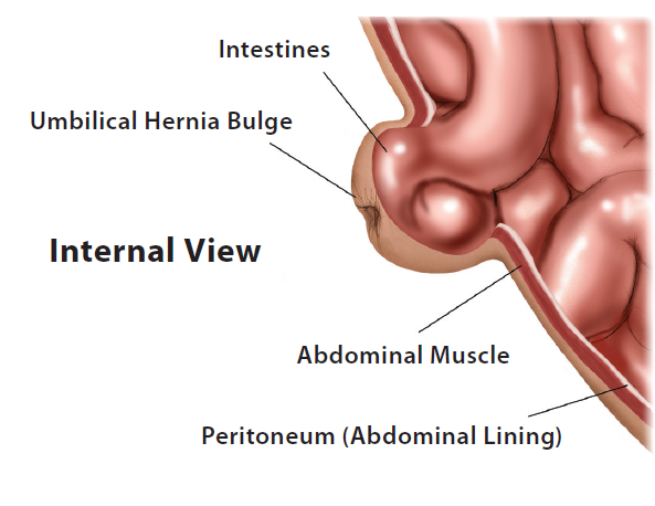 Adult Umbilical Hernia