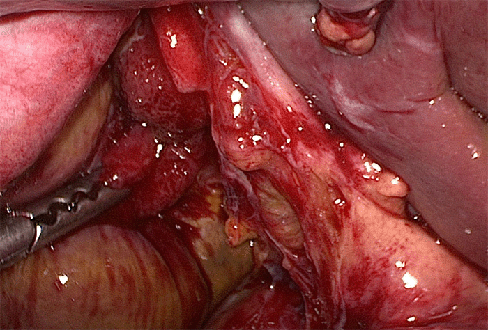 Note perforation at the junction of infundibulum and cystic plate; laparoscopic grasper pointing to rupture