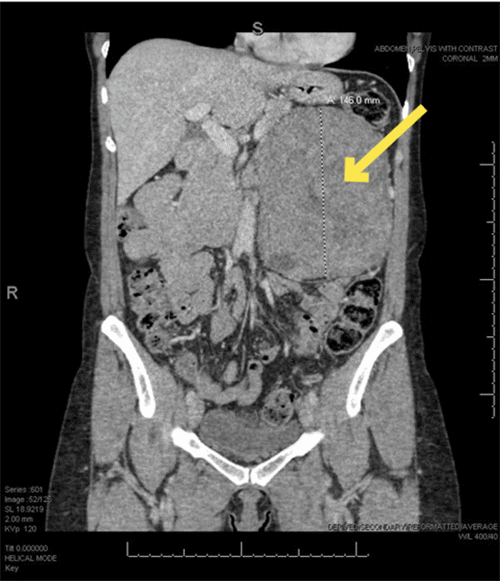 B) Coronal at its largest dimensions; images were used for preoperative planning and visualization of planes of dissection