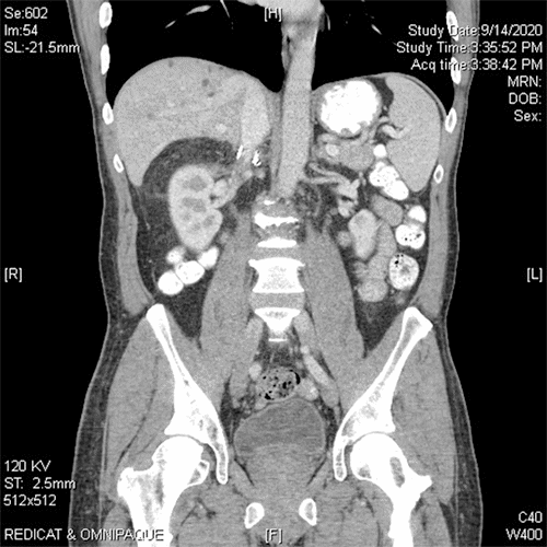 B) imaging post-surgery following resection of the right adrenal angiosarcoma