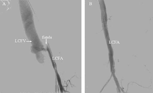 Figure 6. A. Recurrent left sided AVF, prior to stent deployment. Fistula is seen between the common femoral artery and vein. B. Angiogram after stent deployment. Fistula no longer visualized. LCFV=left common femoral vein; LCFA=left common femoral artery.