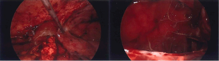 Laparoscopic views obtained during surgical drainage and fenestration of the abdominal pseudocyst. (A) Visualization of the thick-walled, fibrotic pseudocyst cavity in the pelvis after evacuation of serous fluid contents. (B) Internal view of the hollow pseudocyst cavity, demonstrating its smooth lining before partial wall resection/fenestration