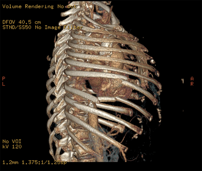 Traumatic Lung Herniation, Repair With Rib Fixation ACS