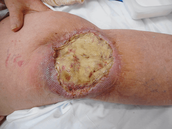 Figure 5. GammaGraft coverage of knee wound 