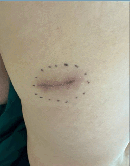 Clinical photograph on POD 36 following the initial incision and drainage with incisional biopsy showing the state of the wound and residual/recurrent tumor prior to definitive wide local excision by the surgical oncology service