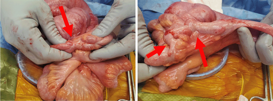 Note circumferential sclerotic rinds throughout distal small bowel that were amenable to blunt lysis that relieved her obstruction.