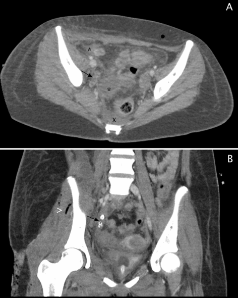 Figure 2. CT abdomen and pelvis with contrast. (A) Axial image demonstrates multiple abscesses (*), free fluid(x), inflammatory changes of the subcutaneous and intra abdominal fat and enlarged pelvic appendix (arrow). (B) Coronal image shows dilated appendix with appendicolith (arrow). Postoperative intramuscular air seen (>).