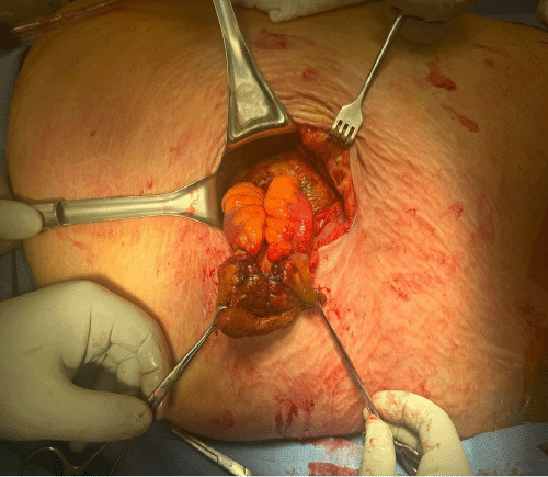Intraoperative photograph during exploration of the left flank hernia, revealing a loop of necrotic, strangulated small bowel protruding through a defect in the hernia sac