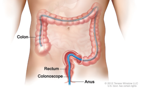 Colonoscopy | ACS