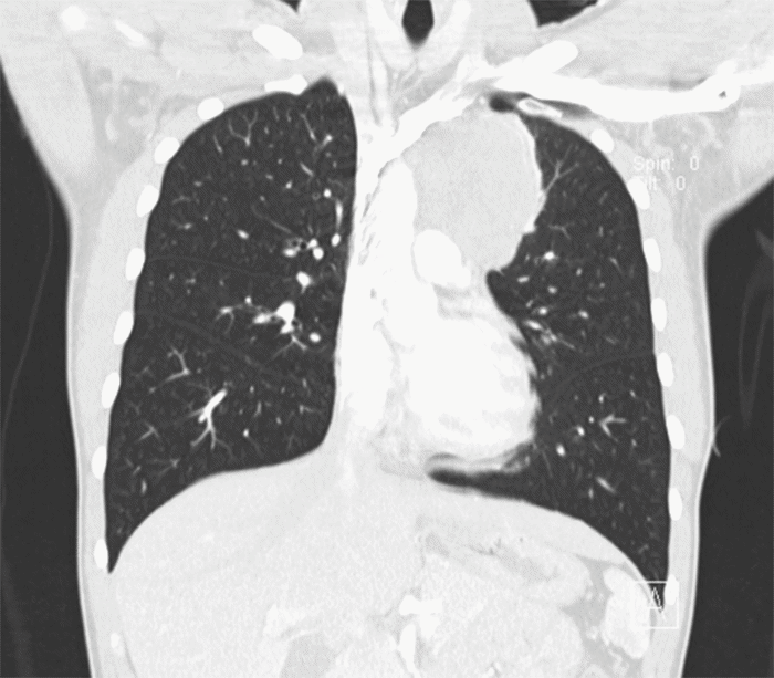 Mass is shown abutting the thoracic aorta; also no well-defined fat plane between the mass and origin of the left subclavian artery or left common carotid artery